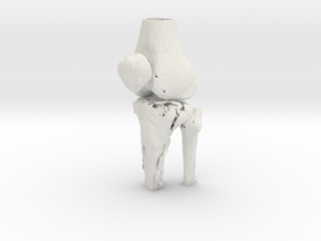 Knee - Proximal Tibia Fracture (Tibial Plateau) in White Natural Versatile Plastic