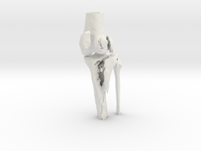 Knee - Proximal Tibia Fracture (Tibial Plateau) in White Natural Versatile Plastic
