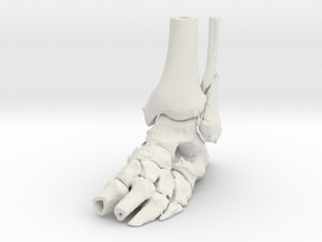 Fibula Fracture in White Natural Versatile Plastic