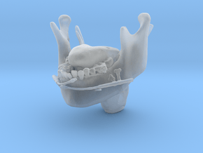 Subject 2d | Mandible + Tongue + Distractors (Befo in Clear Ultra Fine Detail Plastic