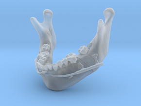 Subject 2i | Mandible + Distractors (After IMDO) in Clear Ultra Fine Detail Plastic