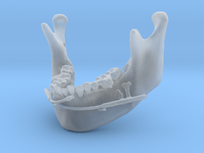 Subject 2b | Mandible + Distractors (Before IMDO) in Clear Ultra Fine Detail Plastic