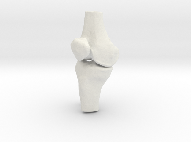 Knee - Proximal Tibia Fracture in White Natural Versatile Plastic