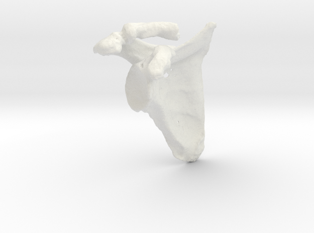 Shoulder - Right Arthritic Scapula in White Natural Versatile Plastic