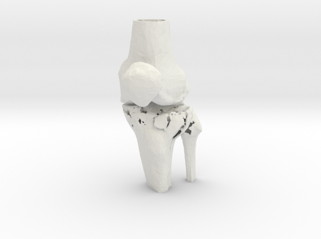 Knee - Proximal Tibia Fracture (Tibial Plateau)   in White Natural Versatile Plastic