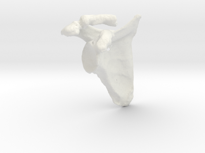 Shoulder - Right Arthritic Scapula 3d printed