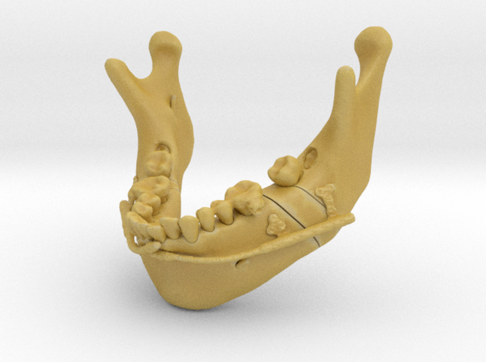 Subject 2i | Mandible + Distractors (After IMDO) 3d printed 