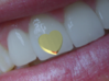 Tooth Art- Heart 3d printed 